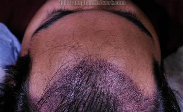 Hair transplant surgery before and after photos