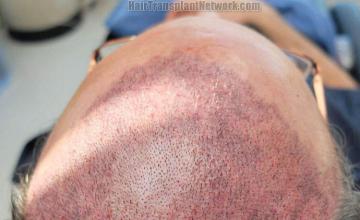 Surgical hair transplantation result photographs