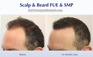 Hair restoration procedure before and after pictures