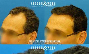 Hair transplantation surgery before and after photos