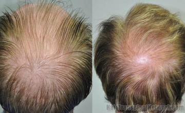 Hair transplantation surgery before and after pictures