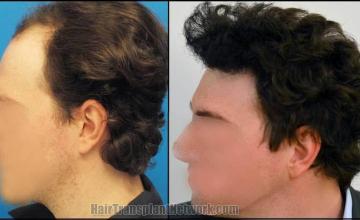 Before and after hair transplantation result photographs