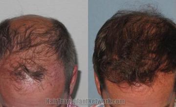 Hair restoration procedure before and after pictures