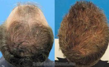 Back view before and after hair transplantation photos