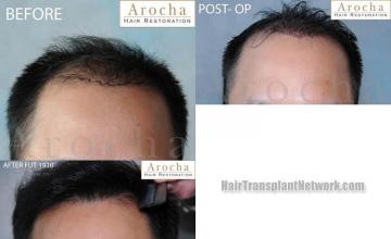 Hair restoration procedure before and after results