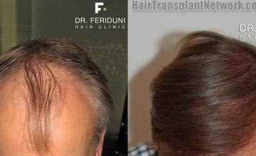 Top view before and after hair restoration results