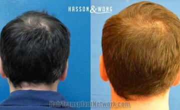 Hair restoration procedure before and after pictures