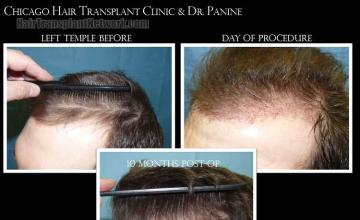 Hair transplantation surgery before and after pictures