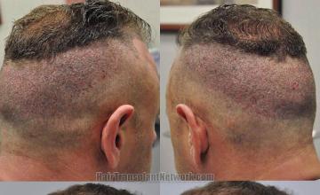 Hair restoration procedure before and after pictures