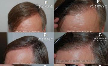 Hair replacement surgery before and after images