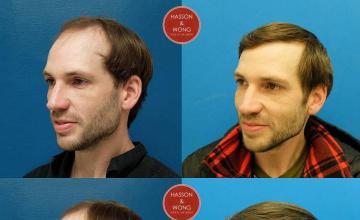 Hair transplantation surgery before and after pictures