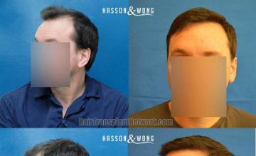 Hair transplantation surgery before and after pictures