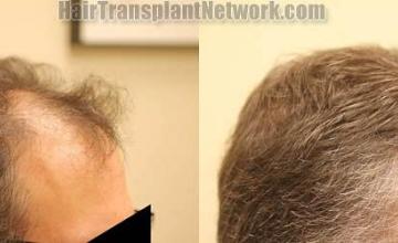 Hair transplantation surgery before and after photos