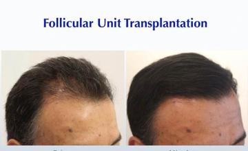 Hair restoration procedure before and after result images