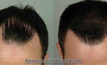 Hair restoration procedure before and after results