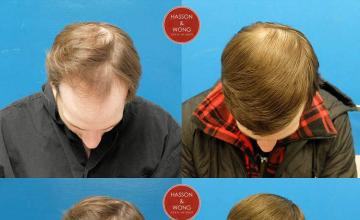 Hair transplantation surgery before and after photos