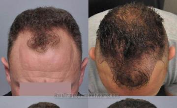 Hair transplantation surgery before and after photos