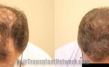 Hair restoration procedure before and after results