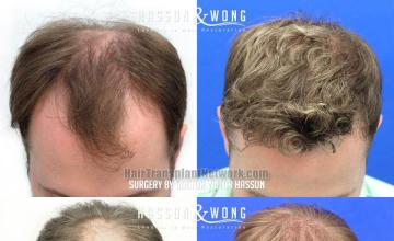 Before and after hair restoration procedure images