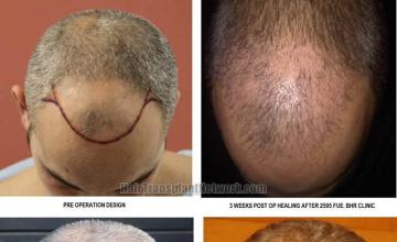 Hair transplantation surgery before and after photos