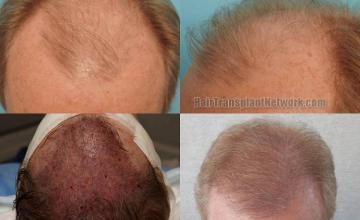 Hair transplantation surgery before and after photos