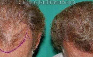 Hair restoration procedure before and after results