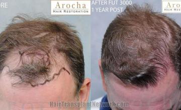 Hair transplantation surgery before and after photos