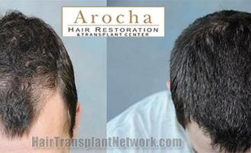 Hair transplantation surgery before and after images