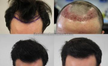 Hair restoration procedure before and after results