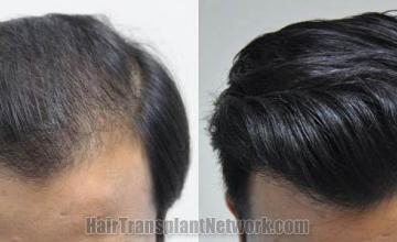 Hair restoration procedure before and after results