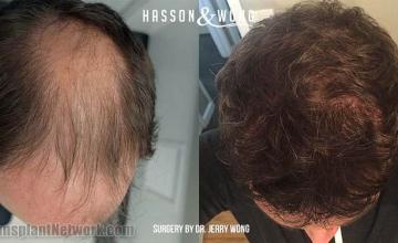 Hair restoration procedure before and after results