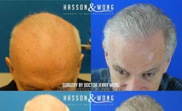 Hair transplantation surgery before and after images