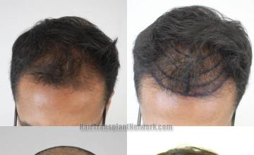 Before and after hair restoration procedure images