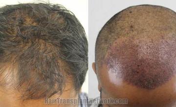 Hair transplantation surgery before and after images