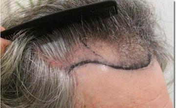 Hair restoration procedure results