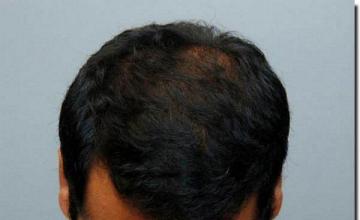 Hair restoration procedure results