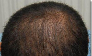 Hair restoration procedure results