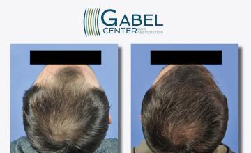 Hair restoration procedure before and after results