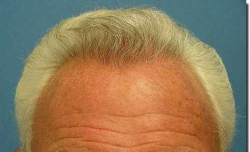 Hair restoration procedure results