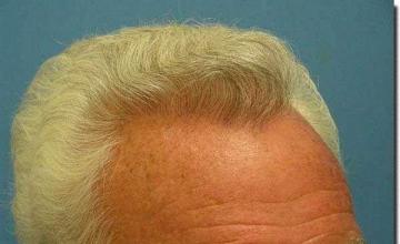 Hair restoration procedure results