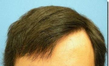 Hair restoration procedure results