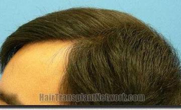 Hair restoration procedure results