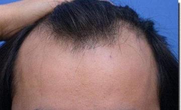 Hair restoration procedure results