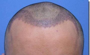 Hair restoration procedure results