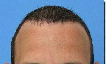 Hair restoration procedure results