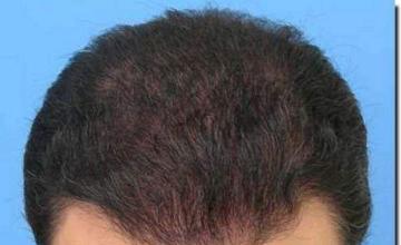 Hair restoration procedure results