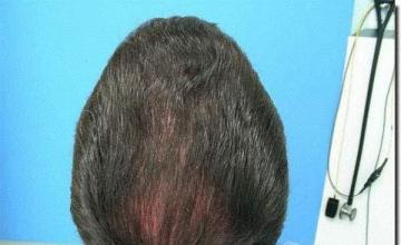 Hair restoration procedure results