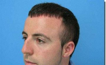 Hair restoration procedure results