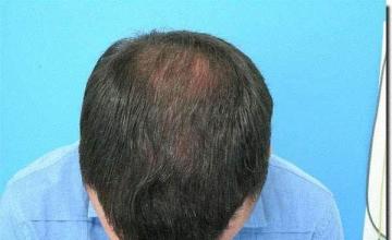 Hair restoration procedure results