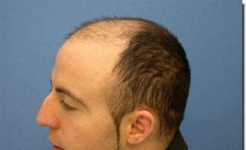 Hair restoration procedure results